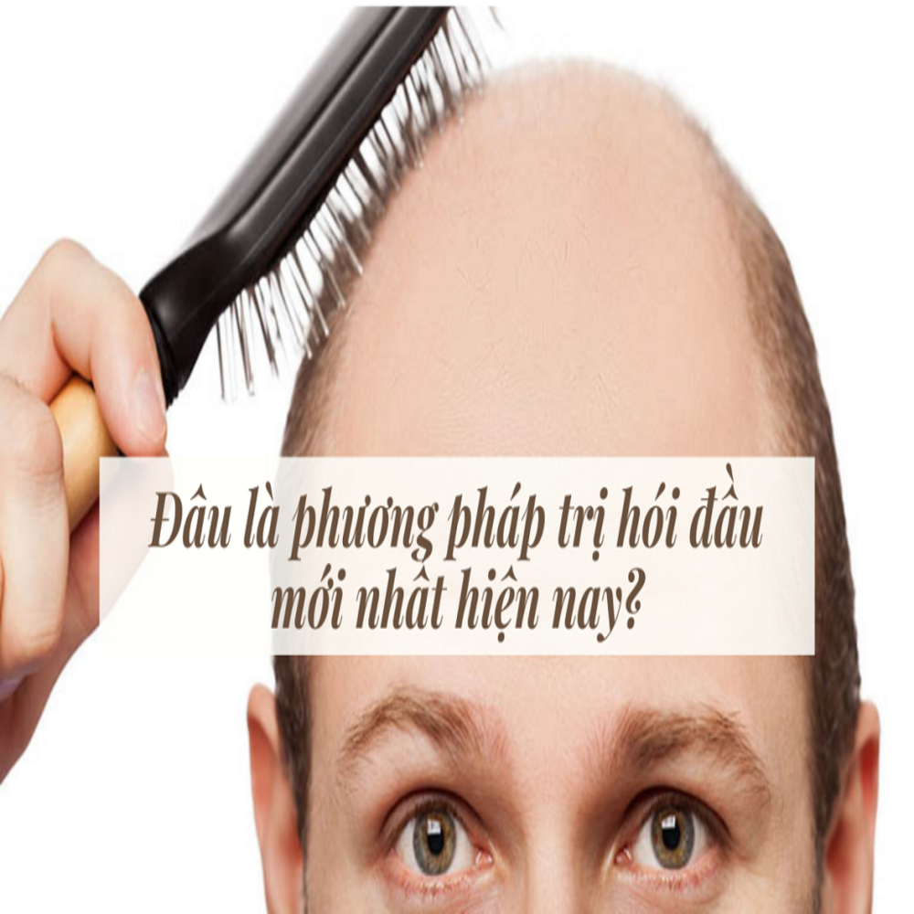 Bật mí phương pháp trị hói đầu mới nhất được chuyên gia Mỹ công nhận